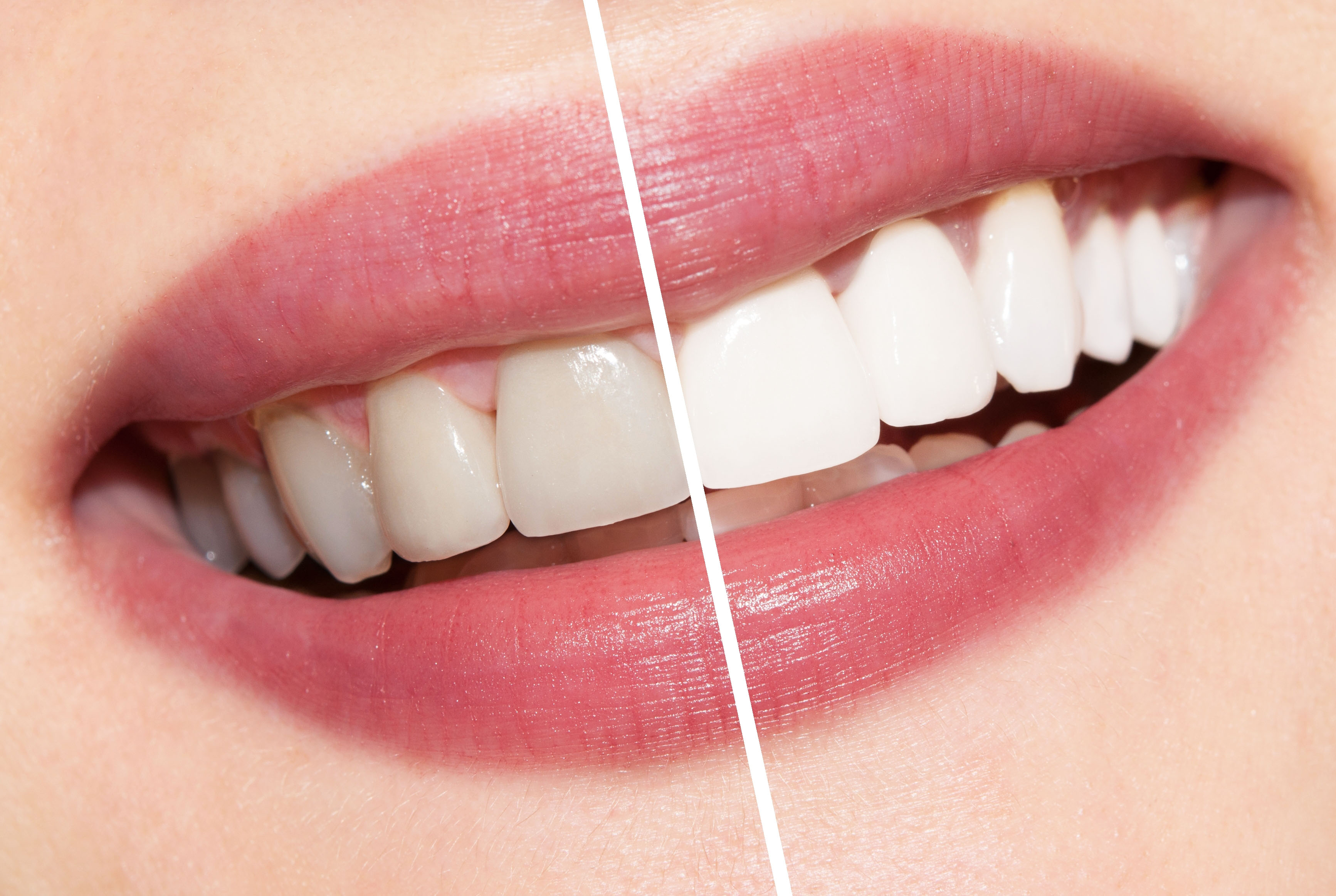 Teeth whitening in Mount Waverley