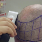 Hair transplant in Brisbane