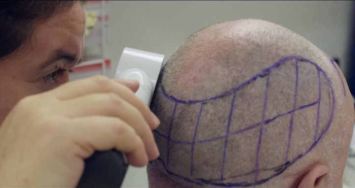 Hair transplant in Brisbane