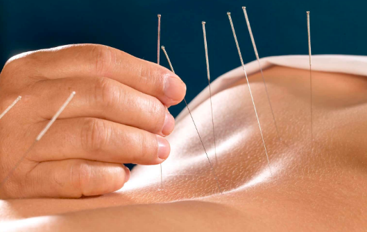 Acupuncture Clinic Pickering