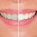 cosmetic dentist in Santa Ana