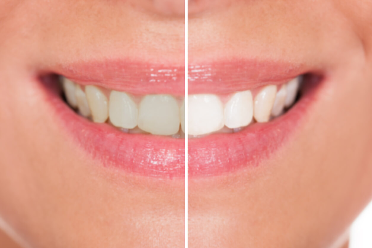 cosmetic dentist in Santa Ana