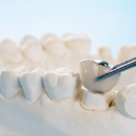 Dental Crowns Gold Coast