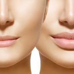Lip Fillers