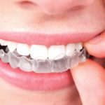 affordable braces