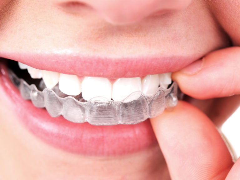 Affordable Braces Strong Invisible Braces 2020