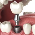 Liverpool implant dentist
