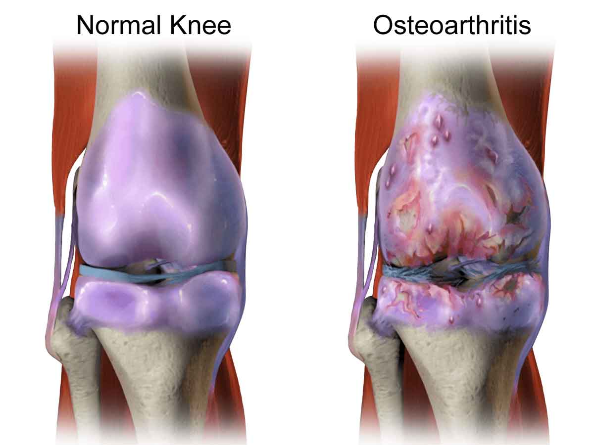 osteoarthritis treatment Brisbane