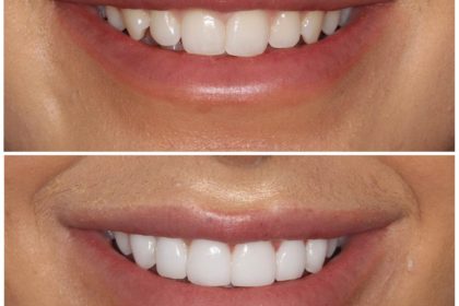 natural looking veneers