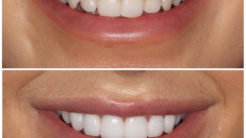 natural looking veneers