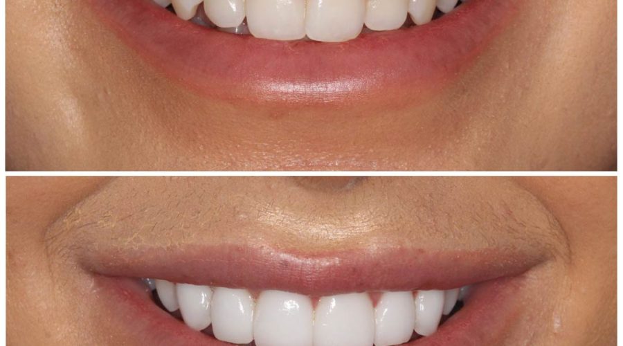 natural looking veneers