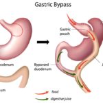 bypass stomach