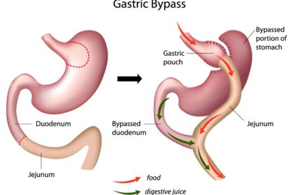bypass stomach