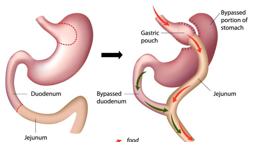 bypass stomach