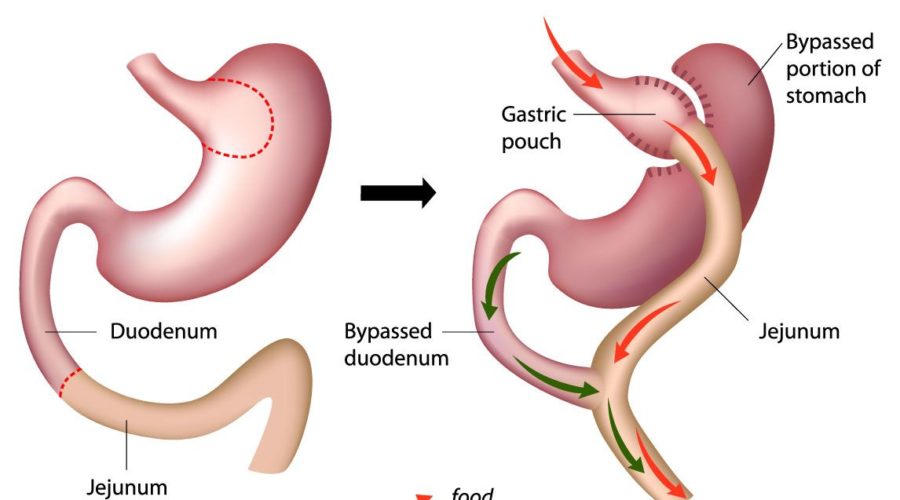 bypass stomach
