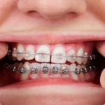 Clear braces
