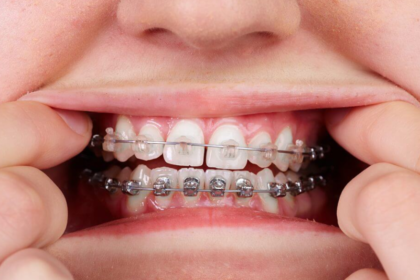 Clear braces
