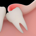 emergency tooth extraction