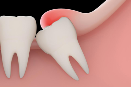 emergency tooth extraction