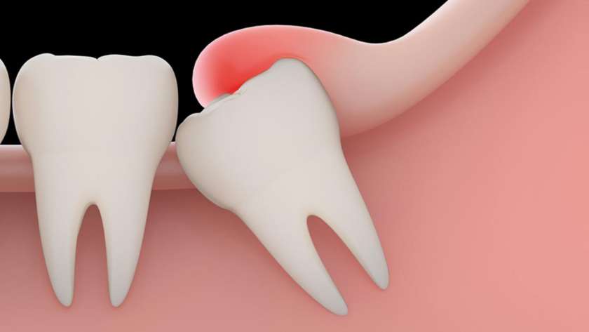 emergency tooth extraction
