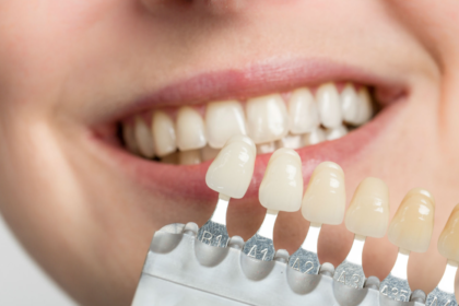 Porcelain dental veneers