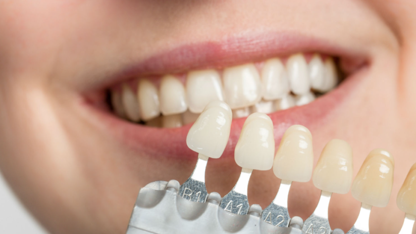 Porcelain dental veneers