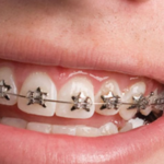 orthodontic treatment