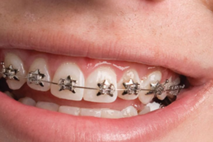 orthodontic treatment