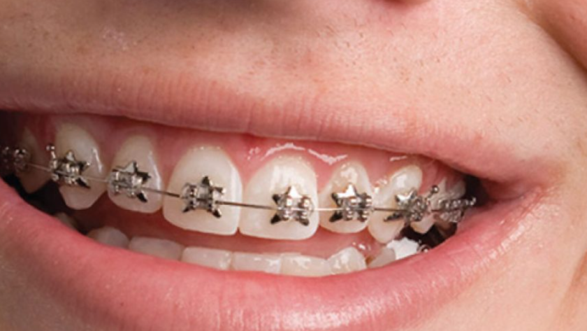 orthodontic treatment