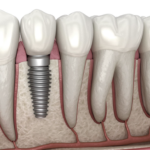 Dental implants in Ottawa