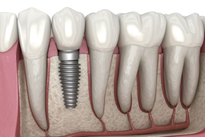 Dental implants in Ottawa