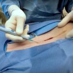 electrosurgical instruments