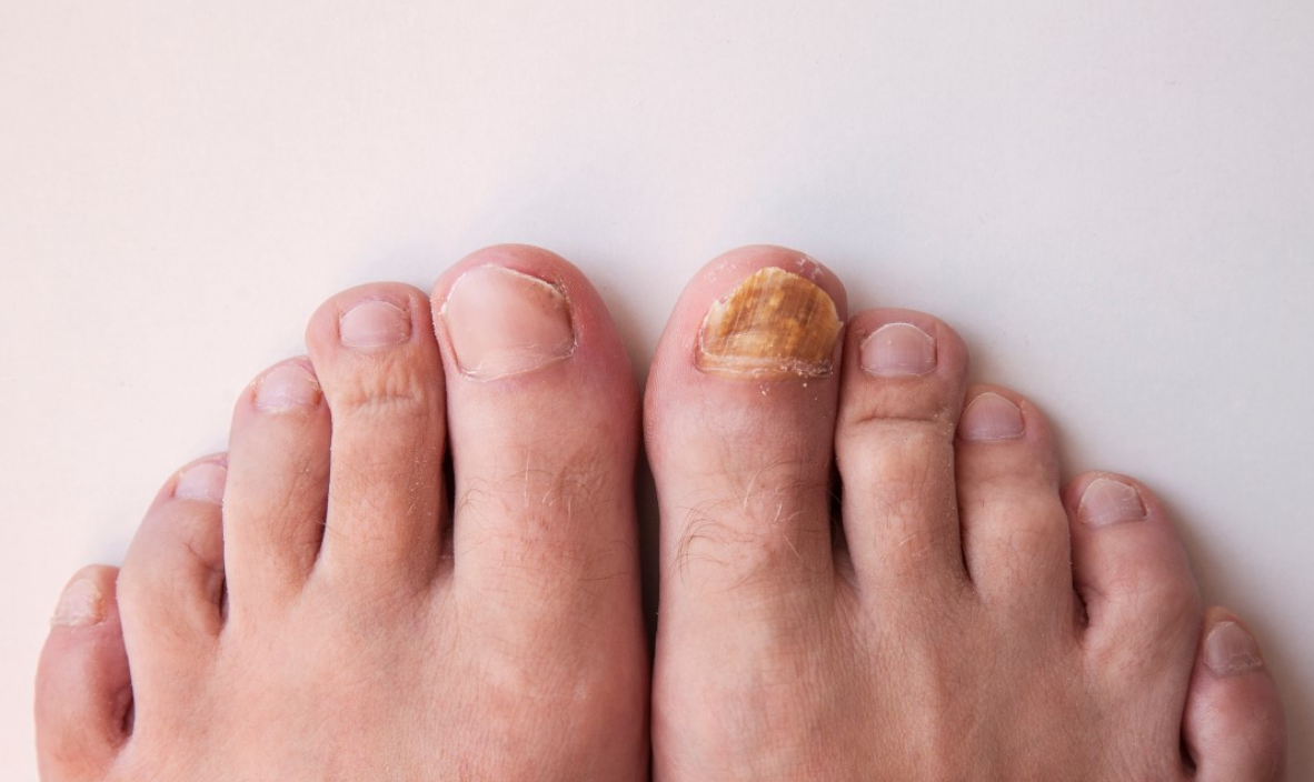 7. Colorful Fungal Nail Treatment - wide 2