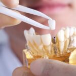 dental implants in Campsie