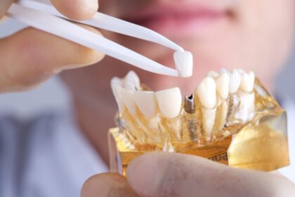 dental implants in Campsie