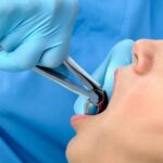 emergency tooth removal