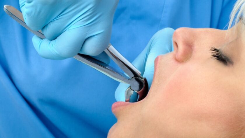 emergency tooth removal