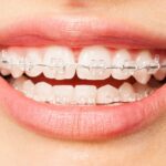 cosmetic braces in Victoria