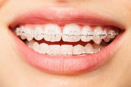 cosmetic braces in Victoria