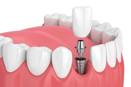 dental implants in Northern Rivers.