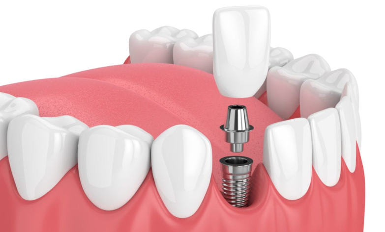 dental implants in Northern Rivers.