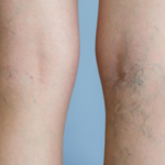 painful veins
