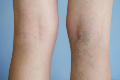 painful veins
