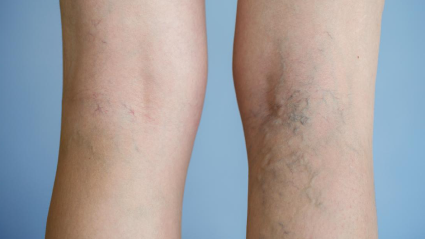 painful veins