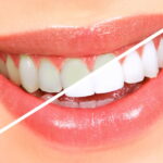 Tooth whitening