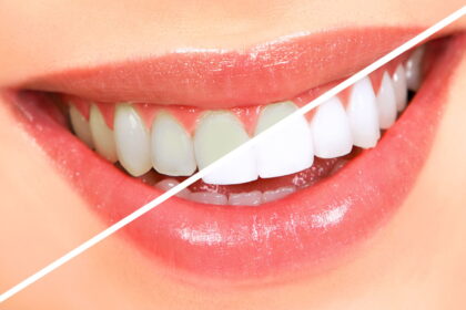 Tooth whitening