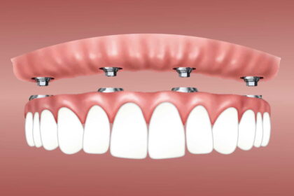 dental implants