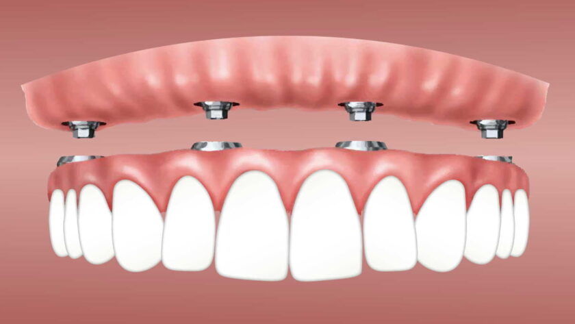 dental implants
