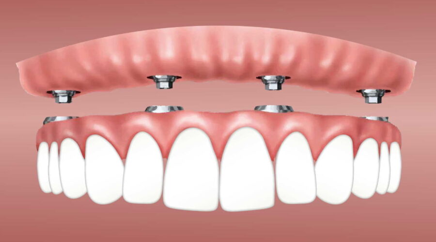 dental implants