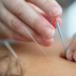 Acupuncture in Epsom